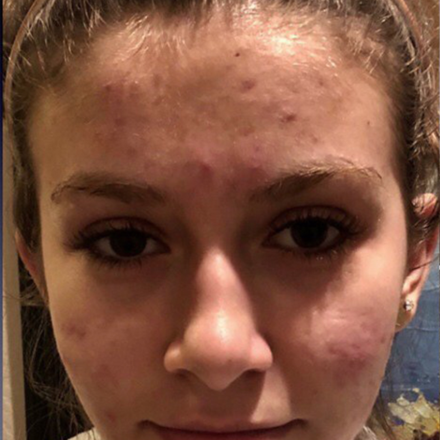 Dermatology Acne Before